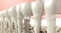 Dental Implants in Litchfield Park, Arizona