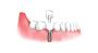 Dental Implants in Surprise, Arizona