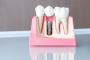 Dental Implants in Kingman, Arizona