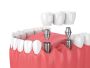 Affordable Tooth Replacement Near Me – Restore Your Smile To