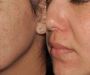 Lumecca IPL Treatment Burnaby – Reveal Clear, Radiant Skin