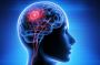 Best Brain Tumors Treatment in San Antonio, TX