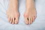 How Safe Is Minimally Invasive Bunion Surgery?