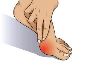5 Effective Exercises for Hallux Valgus Relief
