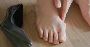 5 Keyhole Bunion Surgery Techniques Explained