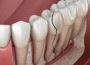 Cracked Tooth Treatment | Effective Solutions at Capendo Cracked Tooth Treatment | Effective Solutions at Capendo