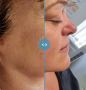 Effective Electrolysis Hair Removal in Vale