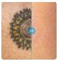 Tattoo Removal Cardiff