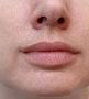 Botox Treatments in Cardiff fora Youthful Look at Vale Laser