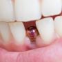 Get Permanent Dental Implants in Howrah