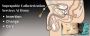 Suprapubic Catheterization Procedure: A Comprehensive Guide
