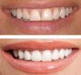 What Are The Benefits Of Teeth Cosmetic Bonding?