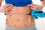 Liposuction in Lahore