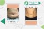 tummy tuck in lahore