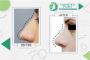 best rhinoplasty surgeon in lahore  
