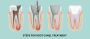 How Successful Is Root Canal Treatment?