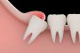 Simple Wisdom Tooth Extraction Recovery Time