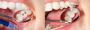 What are the advantage of Composite Fillings?