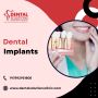 Best Implantologist for Dental Implants in Bangalore