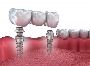 Get Your Same Day Crowns Today