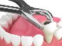 Teeth Extractions Near Me