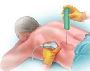 What is the Chemotherapy Cost in India?