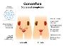5 Effective Treatments for Gonorrhoea You Should Know