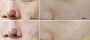 Experience Youthful Skin with a Carboxy CO2 Facial Treatment