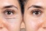 Best Skin Rejuvenation in Hazlemere