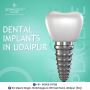 Best dental implants in udaipur