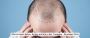 What to Expect Before, During, and After a Hair Transplant