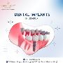 Restore Your Smile with Dental Implants in Udaipur 