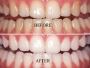 Brighten Your Smile with Teeth Whitening in Santa Clara