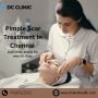pimple scar treatment in chennai