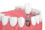 Implant procedure in Tomball TX