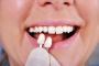 Better Your Appearance With porcelain crowns Tallahassee FL
