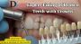 Expert Fixing of Broken Teeth with Crowns – Delatite Dental 