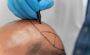 Get Natural Results with FUE Hair Transplant in Greater Kail