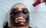 Carbon Peel Treatment in Delhi - The perfect solution to glo