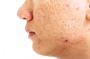 Acne Scar Treatment in Delhi - Transform Your Skin