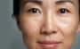 Effective Melasma Treatment in Delhi near me - DWC