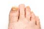 Are You Looking for the Best Toenail Fungus Treatment?