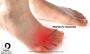 Effective Treatment for Neuromas in Houston