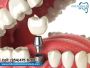 Top Implants Denture Service with the best care and top resu