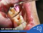 Expert Root Canal Near Me: Davie’s Smile Solution