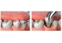 About Orthodontix Dental Clinic Dubai UAE Teeth Extraction