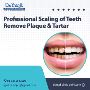 Professional Scaling of Teeth – Remove Plaque & Tartar