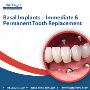 Basal Implants – Immediate & Permanent Tooth Replacement