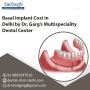 Basal Implant Cost in Delhi by Dr. Garg’s Dental Center