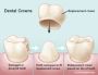 Expert Dental Crowns Treatment in Briarwood, NY Expert Dental Crowns Treatment in Briarwood, NY